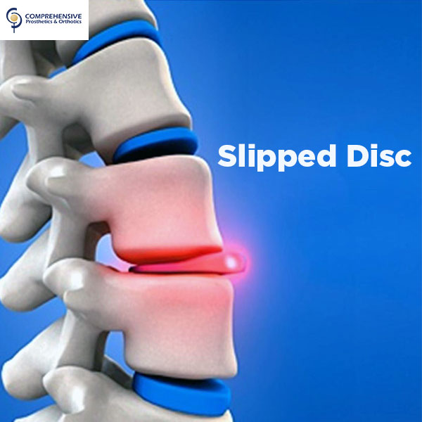 Slipped Disc | Prosthetics & Orthotics | CPO