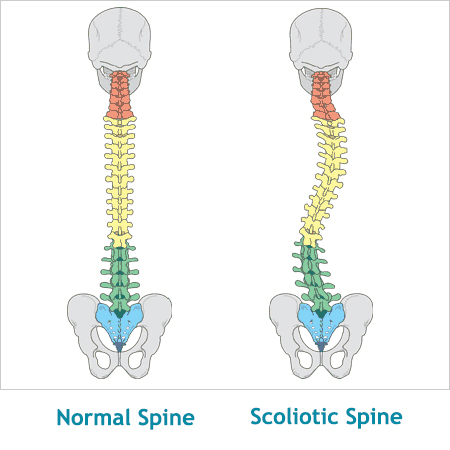 Scoliotoc Spine