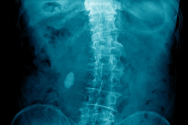 X-ray of a Curved Spine